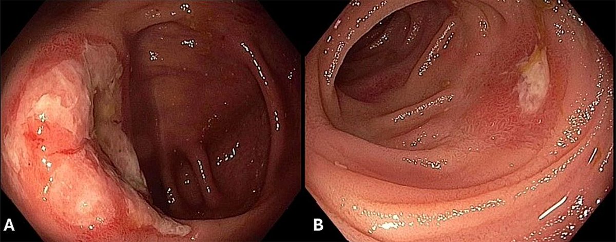 FrontGastro_BMJ's tweet photo. Ileal ulceration and haematochezia in an 83-year old - what's the diagnosis?
Read about it here! https://t.co/mzRIfoTTiX
#GastrointestinalBleeding #GIHaemorrhage #GIHealth #Gastroenterology #DigestiveCare #InternalBleeding #GIConditions #EndoscopicIntervention #UpperGI #LowerGI #HemorrhagicDisorders #ClinicalGastroenterology