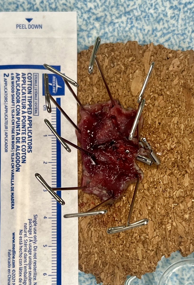 PrashantKediaMD's tweet image. Multiple colon ESDs today. Ascending and sigmoid. Sigmoid def more challenging due to paradoxical motion of the scope @TexasGastros @ASGEendoscopy @ScopingSundays