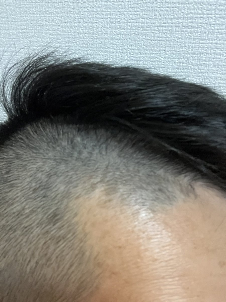 thurube_aga's tweet photo. 🌻リアップをM字部分につけて700日目 https://t.co/YZOA2LSAij