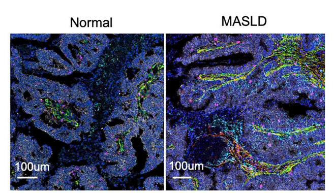 Journal of Clinical Investigation (@jclinicalinvest) on Twitter photo In colorectal cancer, liver metastasis is enhanced by fat build-up in the liver, but the mechanism was unclear.
Ekihiro Seki & team <a href="/CedarsSinai/">Cedars-Sinai</a> now show steatotic liver alters the fibrotic tumor environment, and inhibition of HA synthesis by 4-MU attenuates the effect in mice: In colorectal cancer, liver metastasis is enhanced by fat build-up in the liver, but the mechanism was unclear.
Ekihiro Seki & team <a href="/CedarsSinai/">Cedars-Sinai</a> now show steatotic liver alters the fibrotic tumor environment, and inhibition of HA synthesis by 4-MU attenuates the effect in mice: