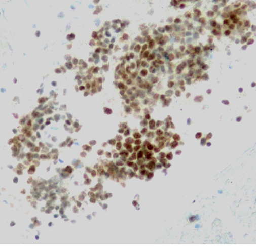 Lola Lozano (@mdlozanoe) on Twitter photo NUT1 on smears in a young male with disseminated lung NSCLC. Notice the characteristic speckled pattern of nuclear stain. Dedicated to my friend and great cytopathologist <a href="/pepeheffernan/">Pepe Jiménez Heffernan</a> ;))
<a href="/IACytology/">International Academy Cytology</a> <a href="/SECitologia/">Sociedad Española de Citología</a> <a href="/SEAP_IAP/">SEAP-IAP</a> <a href="/CytologyEFCS/">EFCS</a> <a href="/cytopathology/">Cytopathology.org</a> <a href="/EfcsYoung/">Young EFCS</a> <a href="/Sinchita_Roy/">Sinchita Roy MD PhD</a> NUT1 on smears in a young male with disseminated lung NSCLC. Notice the characteristic speckled pattern of nuclear stain. Dedicated to my friend and great cytopathologist <a href="/pepeheffernan/">Pepe Jiménez Heffernan</a> ;))
<a href="/IACytology/">International Academy Cytology</a> <a href="/SECitologia/">Sociedad Española de Citología</a> <a href="/SEAP_IAP/">SEAP-IAP</a> <a href="/CytologyEFCS/">EFCS</a> <a href="/cytopathology/">Cytopathology.org</a> <a href="/EfcsYoung/">Young EFCS</a> <a href="/Sinchita_Roy/">Sinchita Roy MD PhD</a>