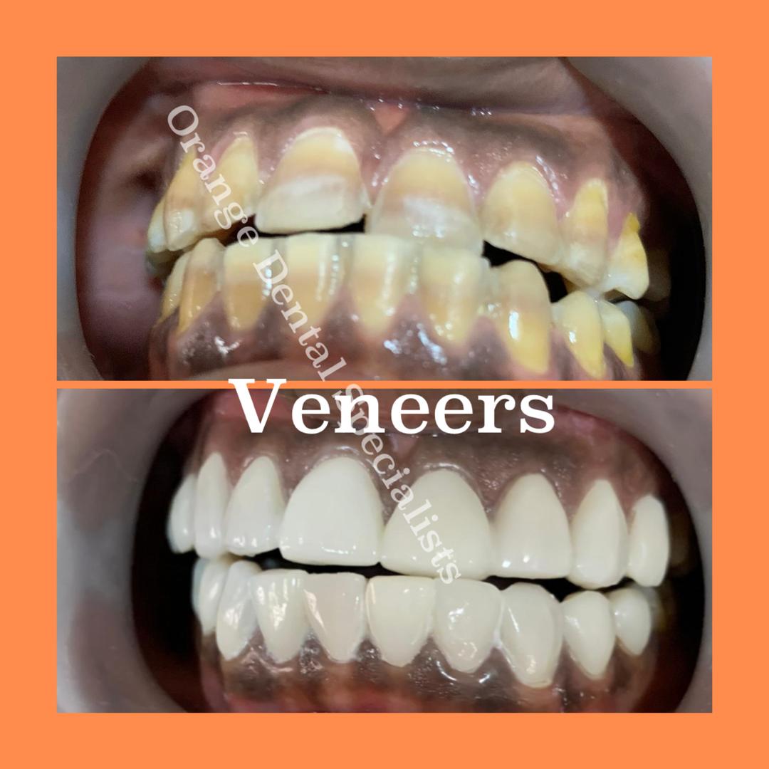 orangedental00's tweet photo. Transform your smile with advanced veneers technology
For dental info, contact:
π±: 08139555482 | 08148289576
π: Captain Cook Building, Alagbaka, Akure, Ondo State.
π§: orangedental00@gmail.com
#oralhealth #dentistinakure #dentition #brokenteeth #toothdecay #teethcase https://t.co/5BbhBQVq9r