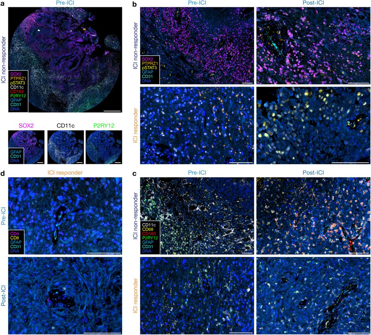Lunaphore (a Bio-Techne brand) (@lunaphore) on Twitter photo Leveraging our COMET⢠technology, a study led by <a href="/jakeyoung11/">Jake Young, MD</a> and <a href="/LabRaleigh/">RaleighLab</a> revealed a novel approach for targeting glioblastoma, the most common and aggressive primary brain cancer.
Read the articleā”ļølink.lunaphore.com/9ct
@NeurosurgeryUCSF <a href="/UCSFCancer/">UCSF Helen Diller Family Comprehensive Cancer Ctr</a> <a href="/UCSF/">UC San Francisco</a> Leveraging our COMET⢠technology, a study led by <a href="/jakeyoung11/">Jake Young, MD</a> and <a href="/LabRaleigh/">RaleighLab</a> revealed a novel approach for targeting glioblastoma, the most common and aggressive primary brain cancer.
Read the articleā”ļølink.lunaphore.com/9ct
@NeurosurgeryUCSF <a href="/UCSFCancer/">UCSF Helen Diller Family Comprehensive Cancer Ctr</a> <a href="/UCSF/">UC San Francisco</a>