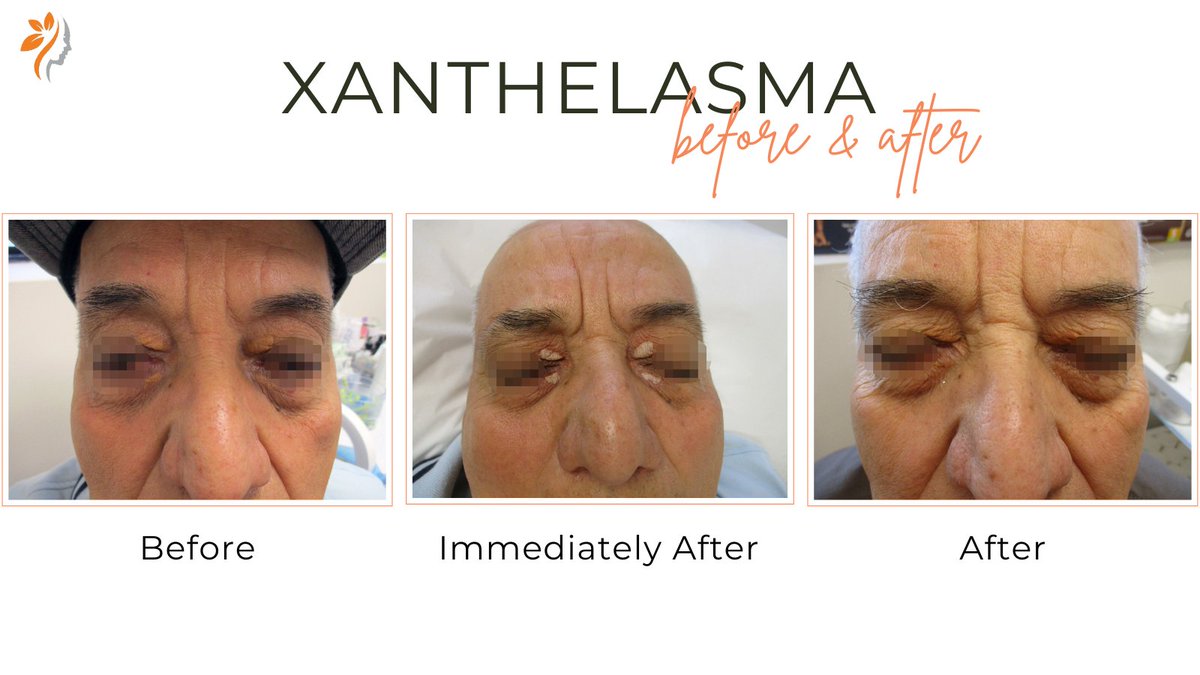 #Xanthelasma is a medical condition characterized by yellowish patches of cholesterol deposits under the skin, typically around the eyelids. While harmless, many individuals seek treatment for cosmetic reasons. Learn more: torontodermatologycentre.com/xanthelasma/