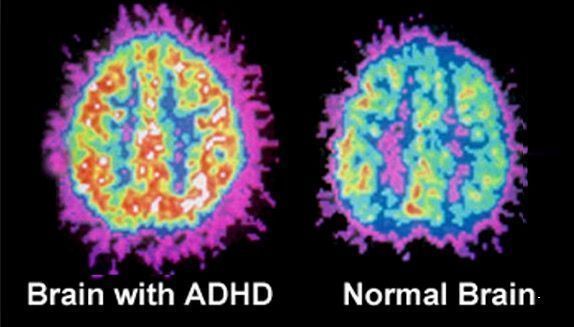 GoBeHERco's tweet image. You've been lied to.

ADHD is not a disorder.

It's a superpower.

Here’s how to turn ADHD into hyper-focus (backed by science):