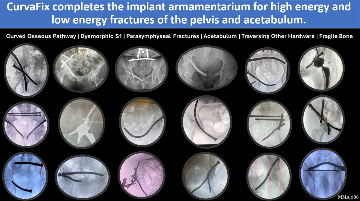 Expanding the Implant Arsenal for Pelvic and Acetabular Fractures

CurvaFix is transforming pelvic fracture fixation by offering a solution for both high-energy and low-energy fractures of the pelvis and acetabulum.