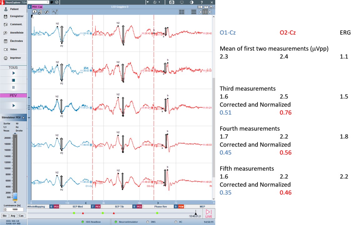 Journal of Clinical Neurophysiology (@jclinneurophys) on Twitter photo Cochard et al describe the use of normalization and correction of VEPs with ERGs to improve reliability and validity of intraoperative VEPs.  Check it out!  👁️⚡bit.ly/4hRBaNR Cochard et al describe the use of normalization and correction of VEPs with ERGs to improve reliability and validity of intraoperative VEPs.  Check it out!  👁️⚡bit.ly/4hRBaNR
