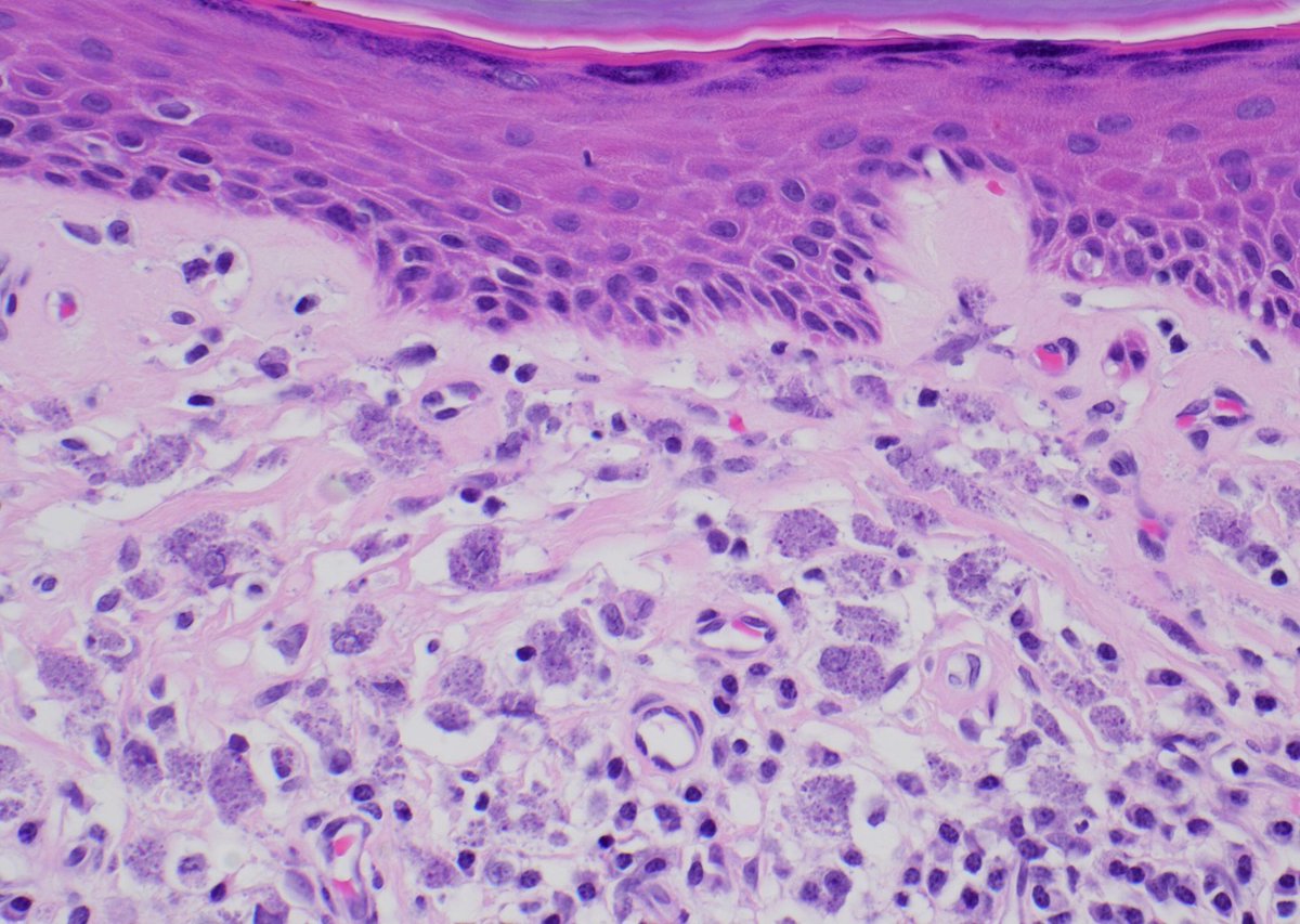 Skin excision. What are the cells in the dermis? What is this patient’s medical history? 
Answer ✅ youtu.be/a8Dh17320AQ
#pathology #pathologists #pathTwitter #dermpath #dermatology #dermatologia #dermtwitter