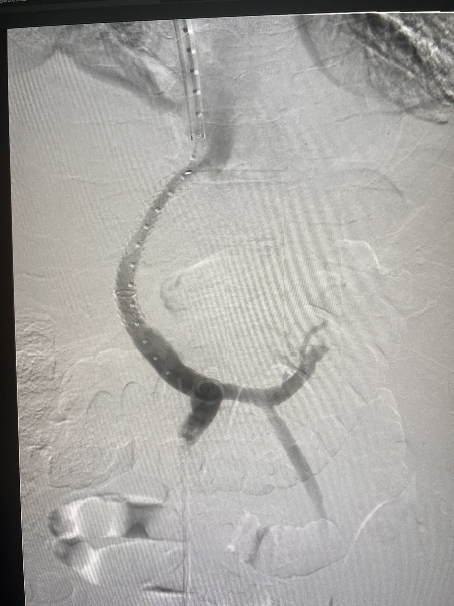 3 TIPS, 1 team, 1 room, done by 4pm in one day (including PV Thrombectomy) - a #VIRad first?