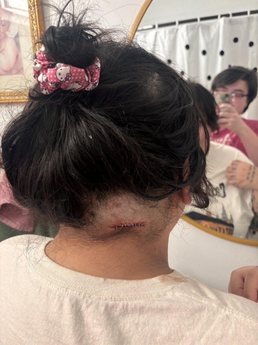 tw: surgery/wound/ post op photo
.
.
surgery went well yesterday but today’s pain is about 8/10. focusing on recovery for a while (im very tired) but i wanted to show yall this crazy ass incision site. feeling like frankenstein’s monster fr 😖
