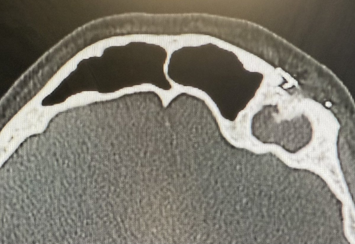 JohnCraigNose's tweet photo. Recurrent #orbitalcellulitis, but settled down before surgery. Easy? Case done, pics maybe after dinner and sleep, time will tell! @henryfordent @MakaryENT @ent_ams @MartaKwiat_ska #DrafIIB #Treph #stent #hope https://t.co/6Y3HH1aaHl