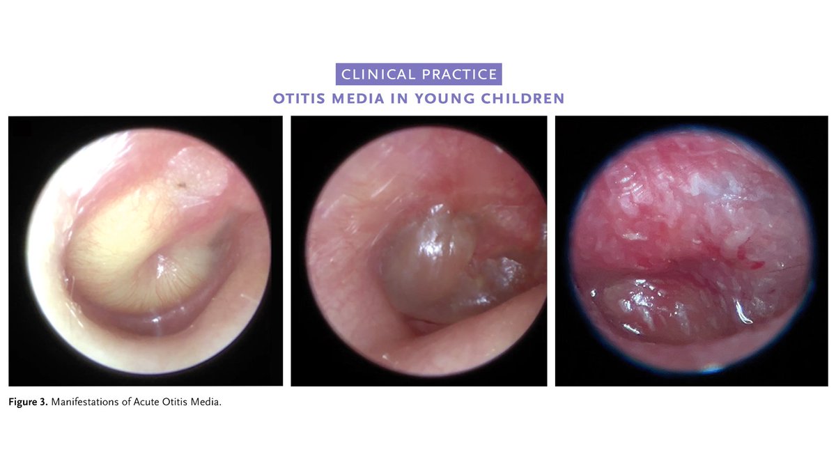 Acute otitis media occurs almost exclusively after a viral upper respiratory tract infection. Children with mild or moderate symptoms can be treated with antibiotics or closely observed.  

Learn more in the Clinical Practice article “Otitis Media in Young Children” by Nader