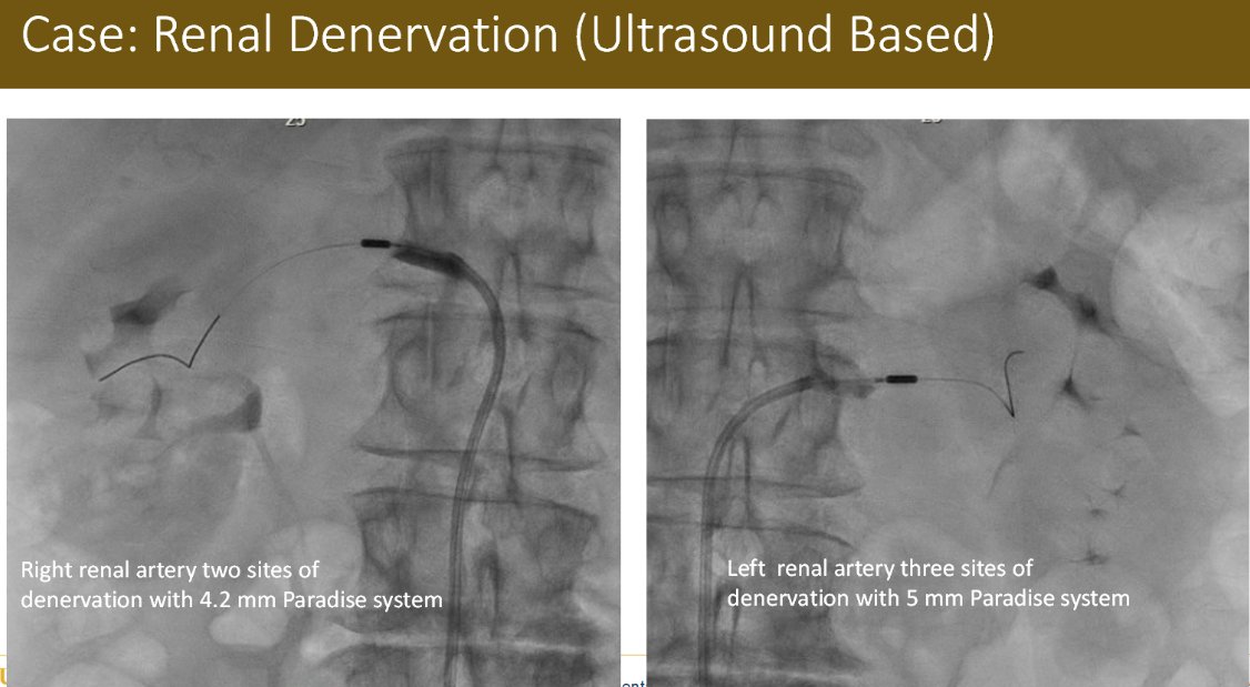 Cath Lab Digest (@cathlabdigest) on Twitter photo 4 Cases: Treating Uncontrolled Hypertension With the Paradise™ Ultrasound Renal Denervation System (uRDN)
Cases are shared by Drs Atreja, Nanjundappa, Gharib/King, and Yaganti.
hubs.ly/Q03gCjG-0
#cardiotwitter <a href="/ReCorMedical/">Recor Medical</a> #renaldenervation 4 Cases: Treating Uncontrolled Hypertension With the Paradise™ Ultrasound Renal Denervation System (uRDN)
Cases are shared by Drs Atreja, Nanjundappa, Gharib/King, and Yaganti.
hubs.ly/Q03gCjG-0
#cardiotwitter <a href="/ReCorMedical/">Recor Medical</a> #renaldenervation