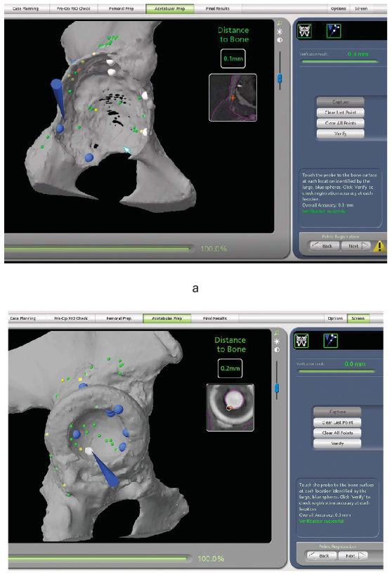 BoneJointJ's tweet photo. In revision total hip arthroplasty robotic assistance provides valuable information for the analysis of bone defects and the formation of reconstruction strategies.

#TotalHipArthroplasty #Robotics #BoneDefect #BJJ

https://t.co/uBZdGi99KJ https://t.co/iEkEhk6LGG