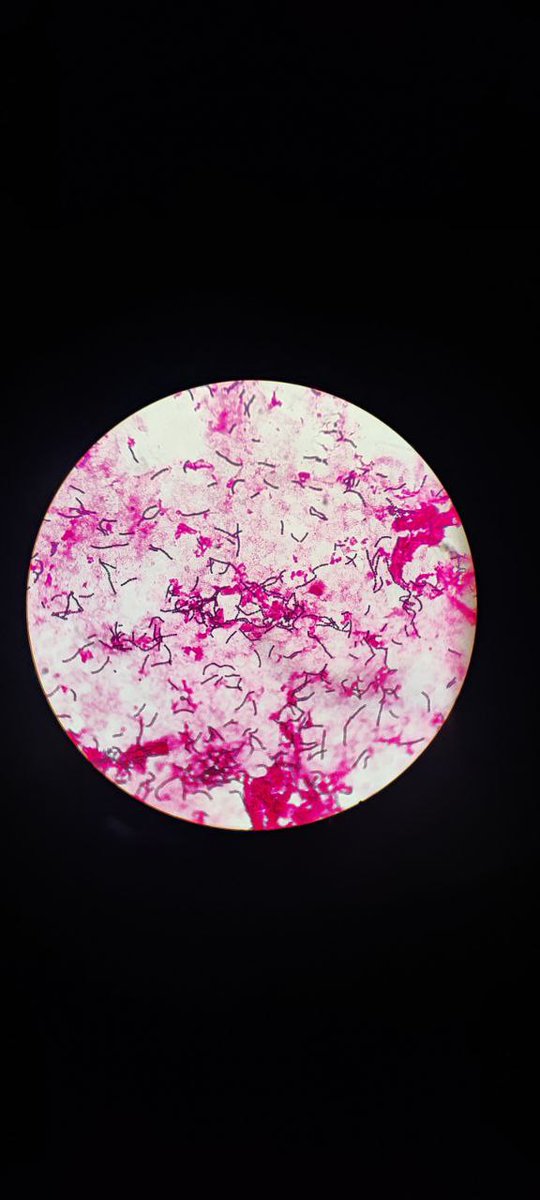 15.2 hours later, the blood culture flagged positive. 

Gram stain shows these beautiful images.

Time is very important in bood culture tests. 

The more the bacterial load, the shorter the time of positivity and more likelyhood of true sepsis.