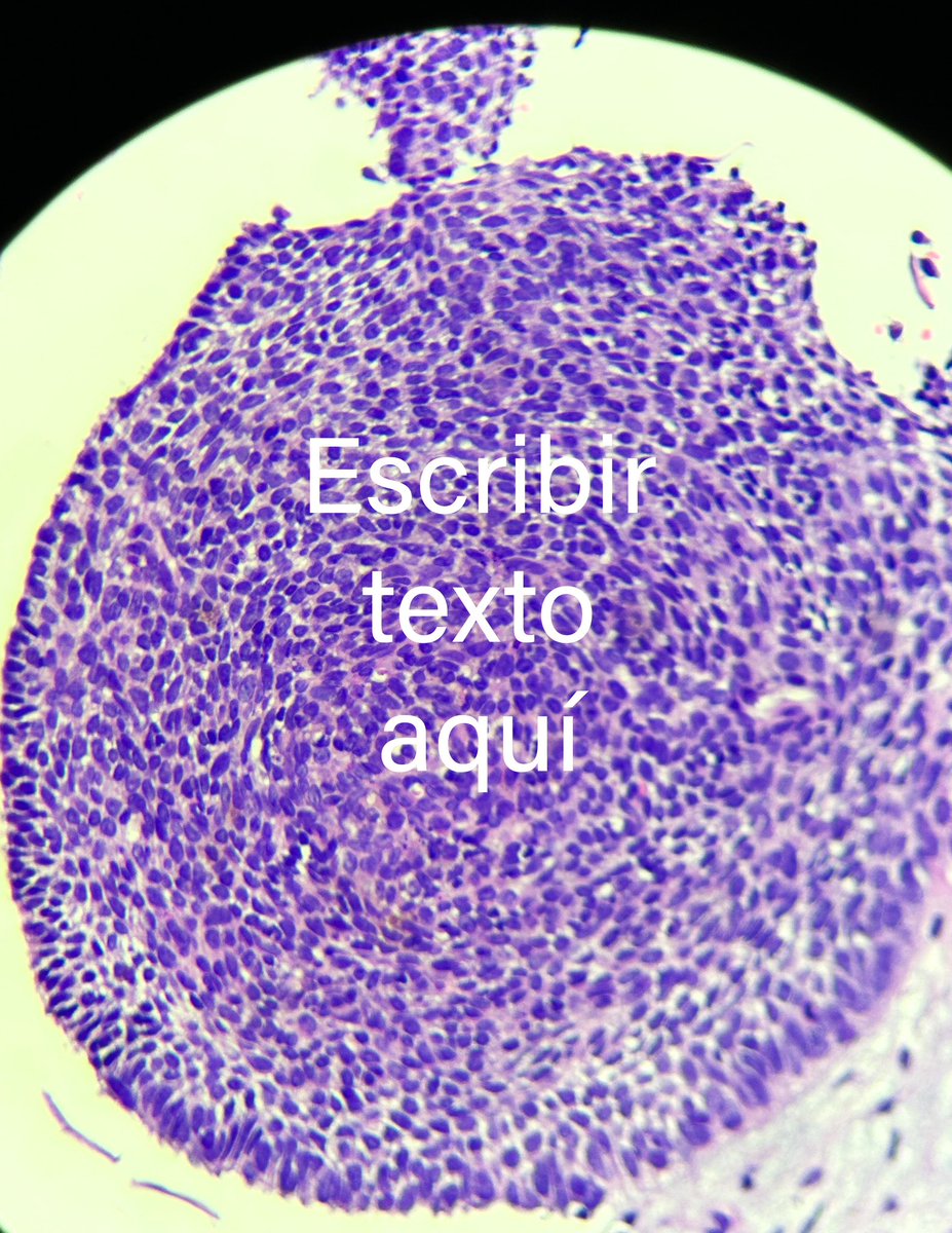Gonzalo De Toro (@gonzadetoro) on Twitter photo Its a crush 😍 #Dermpath #Dermatology #PathTwitter <a href="/HENRYY_MD/">Henry YANG</a> <a href="/pepeheffernan/">Pepe Jiménez Heffernan</a> <a href="/mccalmo/">Tim McCalmont</a> <a href="/melanopath/">Arnaud de la Fouchardiere MD, PhD</a> <a href="/DermwizGuy/">Emmanuel Maicas</a> <a href="/JCandidoXavier/">Jose Candido</a> <a href="/et565/">Etan Marks, DO</a> Its a crush 😍 #Dermpath #Dermatology #PathTwitter <a href="/HENRYY_MD/">Henry YANG</a> <a href="/pepeheffernan/">Pepe Jiménez Heffernan</a> <a href="/mccalmo/">Tim McCalmont</a> <a href="/melanopath/">Arnaud de la Fouchardiere MD, PhD</a> <a href="/DermwizGuy/">Emmanuel Maicas</a> <a href="/JCandidoXavier/">Jose Candido</a> <a href="/et565/">Etan Marks, DO</a>