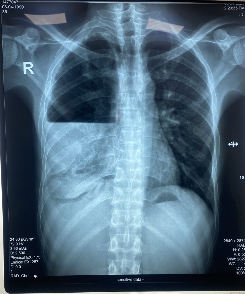 What happened?
#Cxr_findings ?
#Causes ?

#MEDHM #MedX <a href="/IhabFathiSulima/">Dr Ihab Suliman</a>