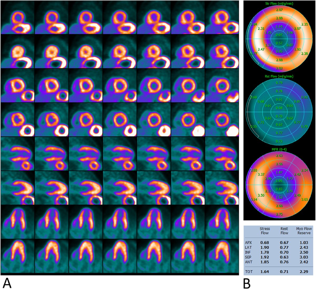 Journal of Nuclear Cardiology (@jncjournal) on Twitter photo Potential role of Rubidium-82 Positron Emission Tomography in Diagnosing Coronary Microvascular Dysfunction in Apical Hypertrophic Cardiomyopathy: An interesting case report! @Nazifkutaiba <a href="/AabuzaidDr/">A.Sami Abuzaid MD,EMHL,FASE,FSCCT,FSCMR,FESC,FACC</a> <a href="/morristownheart/">@MorristownHeart</a> <a href="/DOMSinaiNYC/">Mount Sinai Department of Medicine</a>
Read now👉bit.ly/42l77bu
#cvnuc Potential role of Rubidium-82 Positron Emission Tomography in Diagnosing Coronary Microvascular Dysfunction in Apical Hypertrophic Cardiomyopathy: An interesting case report! @Nazifkutaiba <a href="/AabuzaidDr/">A.Sami Abuzaid MD,EMHL,FASE,FSCCT,FSCMR,FESC,FACC</a> <a href="/morristownheart/">@MorristownHeart</a> <a href="/DOMSinaiNYC/">Mount Sinai Department of Medicine</a>
Read now👉bit.ly/42l77bu
#cvnuc