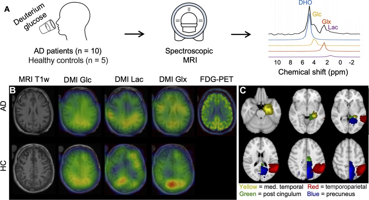Radiology (@radiology_rsna) on Twitter photo Bøgh et al performed deuterium metabolic imaging with FDG PET in patients with Alzheimer disease to investigate any shifts from oxidative to anaerobic metabolism. Read on to find out what they discovered! <a href="/chris_laustsen/">Christoffer Laustsen</a> bit.ly/4ipYEdj Bøgh et al performed deuterium metabolic imaging with FDG PET in patients with Alzheimer disease to investigate any shifts from oxidative to anaerobic metabolism. Read on to find out what they discovered! <a href="/chris_laustsen/">Christoffer Laustsen</a> bit.ly/4ipYEdj