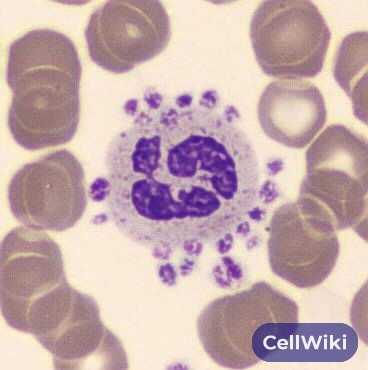 Path4People's tweet photo. 25 y/o Healthy Male for Annual Physical
Platelet Count of 80,000 (nml 150,000-450,000)
PE: Nml, No Petechiae
Peripheral Smear: ⬇️
What is happening and what is the solution?
#pathx #hemex #medx #medicine #bloodbank #pathology #hemeonc https://t.co/g02jZdMiY3
