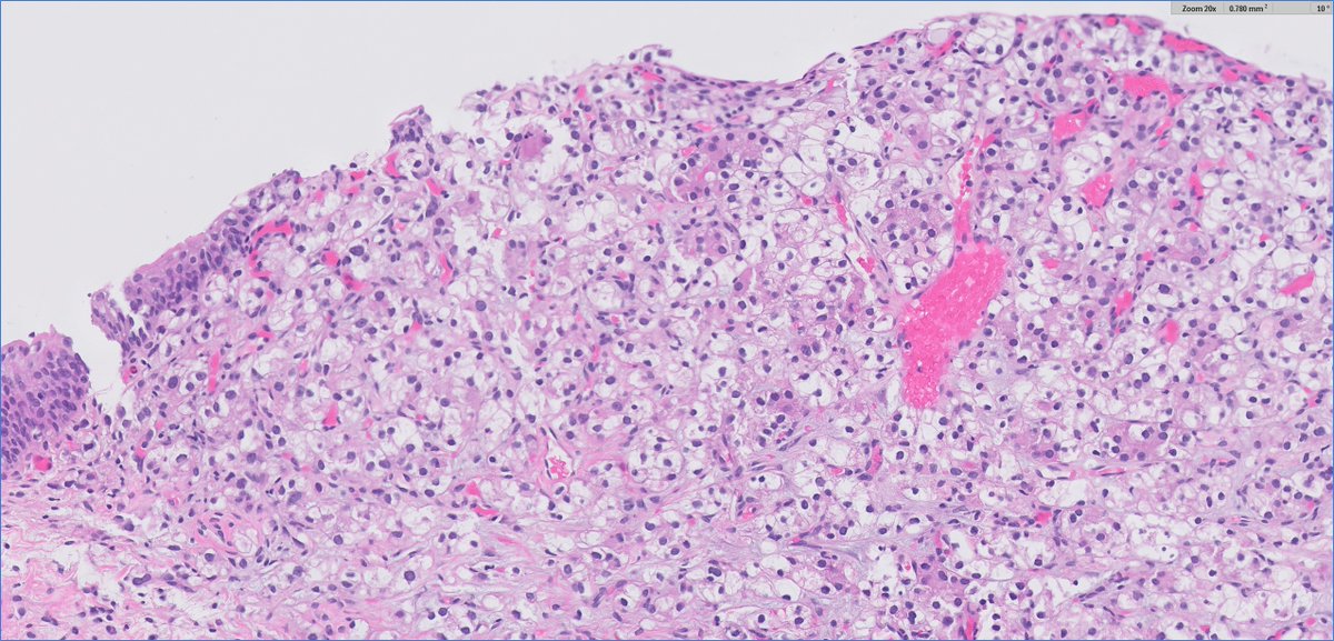 adult human presents with hematuria, bladder mass found, TURBT performed

#GUpath🤨