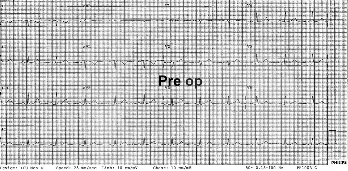 A 71 year old woman is admitted to the ICU from theatre following a prolonged left hemicolectomy.  

She is intubated and requires a low dose noradrenaline (norepinephrine) infusion to maintain her blood pressure.

A routine ECG is taken on arrival - what does it show?  A