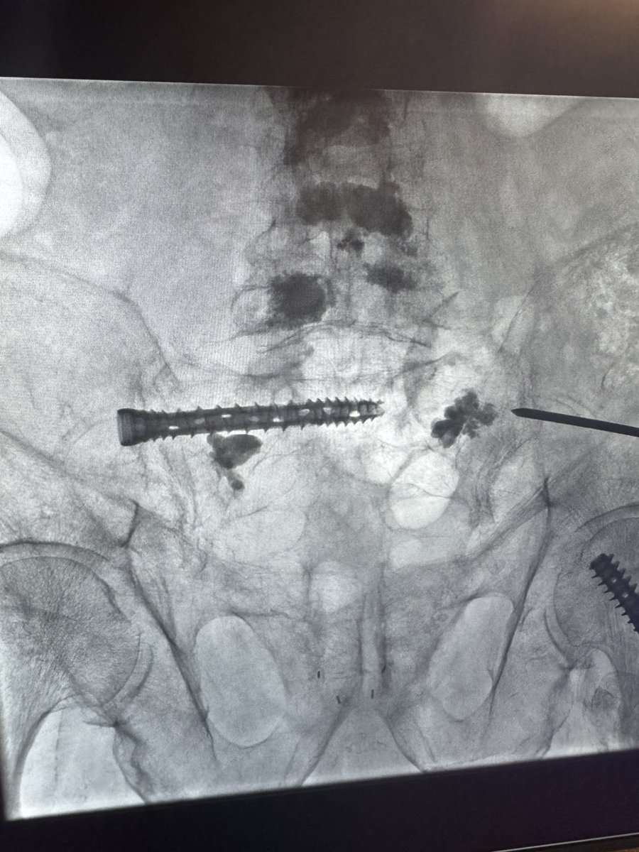 DoctorCliffyy's tweet photo. 86M with severe osteoporosis. Prior multilevel, kyphoplasty and sacral plasty, unsuccessful fracture stabilization in the sacrum. MRI s1 frx with progression.
#Sibone #Torq in S1 10x80&60.
@SIRspecialists
@TheRealDoctorOs @thegestgroup @_backtableMSK @_backtable
#IR #MSK https://t.co/F7NzRoDu83