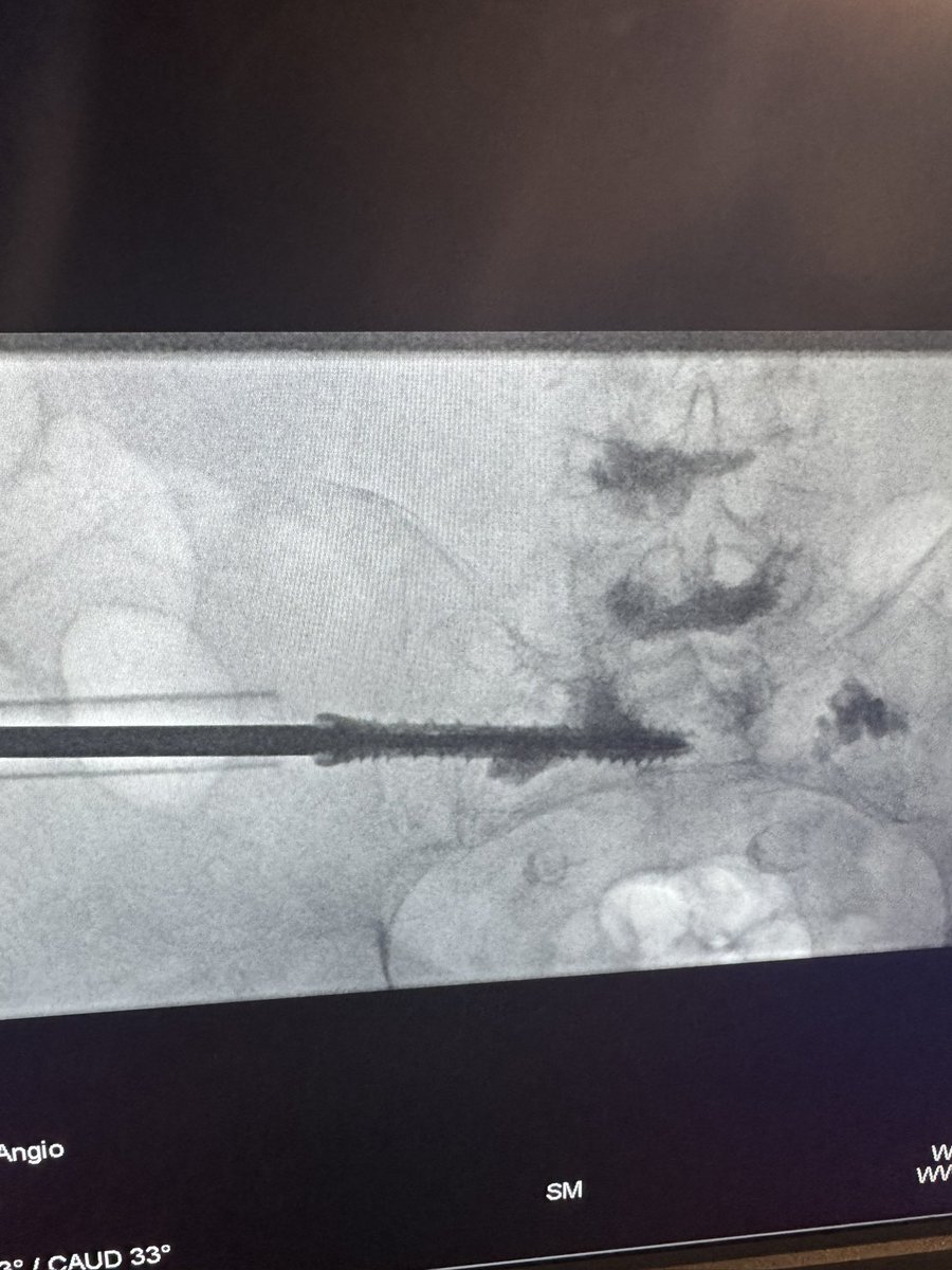 DoctorCliffyy's tweet photo. 86M with severe osteoporosis. Prior multilevel, kyphoplasty and sacral plasty, unsuccessful fracture stabilization in the sacrum. MRI s1 frx with progression.
#Sibone #Torq in S1 10x80&60.
@SIRspecialists
@TheRealDoctorOs @thegestgroup @_backtableMSK @_backtable
#IR #MSK https://t.co/F7NzRoDu83