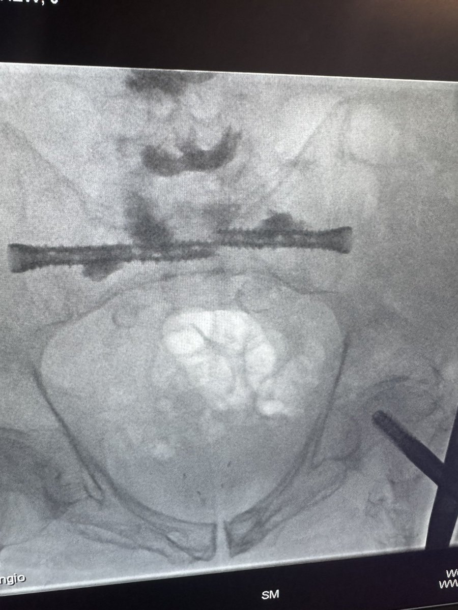 @DoctorCliffyy (@doctorcliffyy) on Twitter photo 86M with severe osteoporosis. Prior multilevel, kyphoplasty and sacral plasty, unsuccessful fracture stabilization in the sacrum. MRI s1 frx with progression.
#Sibone #Torq in S1 10x80&60.
<a href="/SIRspecialists/">Society of Interventional Radiology</a>
<a href="/TheRealDoctorOs/">Osman Ahmed</a> <a href="/thegestgroup/">GEST -Global Embolization Symposium & Technologies</a> <a href="/_backtableMSK/">BackTable MSK</a> <a href="/_backtable/">BackTable Vascular and Interventional</a>
#IR #MSK 86M with severe osteoporosis. Prior multilevel, kyphoplasty and sacral plasty, unsuccessful fracture stabilization in the sacrum. MRI s1 frx with progression.
#Sibone #Torq in S1 10x80&60.
<a href="/SIRspecialists/">Society of Interventional Radiology</a>
<a href="/TheRealDoctorOs/">Osman Ahmed</a> <a href="/thegestgroup/">GEST -Global Embolization Symposium & Technologies</a> <a href="/_backtableMSK/">BackTable MSK</a> <a href="/_backtable/">BackTable Vascular and Interventional</a>
#IR #MSK