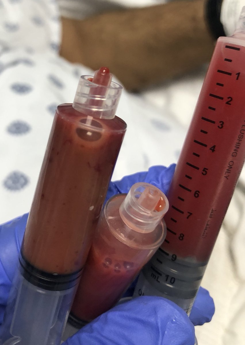 Nasrawi7's tweet photo. Ultrasound guided abscess drainage 
Note that the abscess was not an echoic ( black ) as it was there for almost a month .. patient seen by many physician and was misdiagnosed as lipoma #empocus #POCUS https://t.co/NsRi1PYLWp
