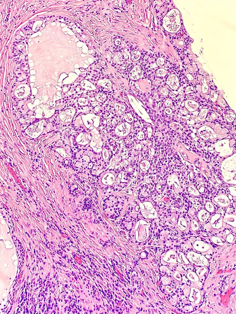Excision of a minor salivary gland mass showing what type of tumor? Answer: buff.ly/Umo2BdL  #PathArt #PathTwitter #MedTwitter buff.ly/CG3dkVl