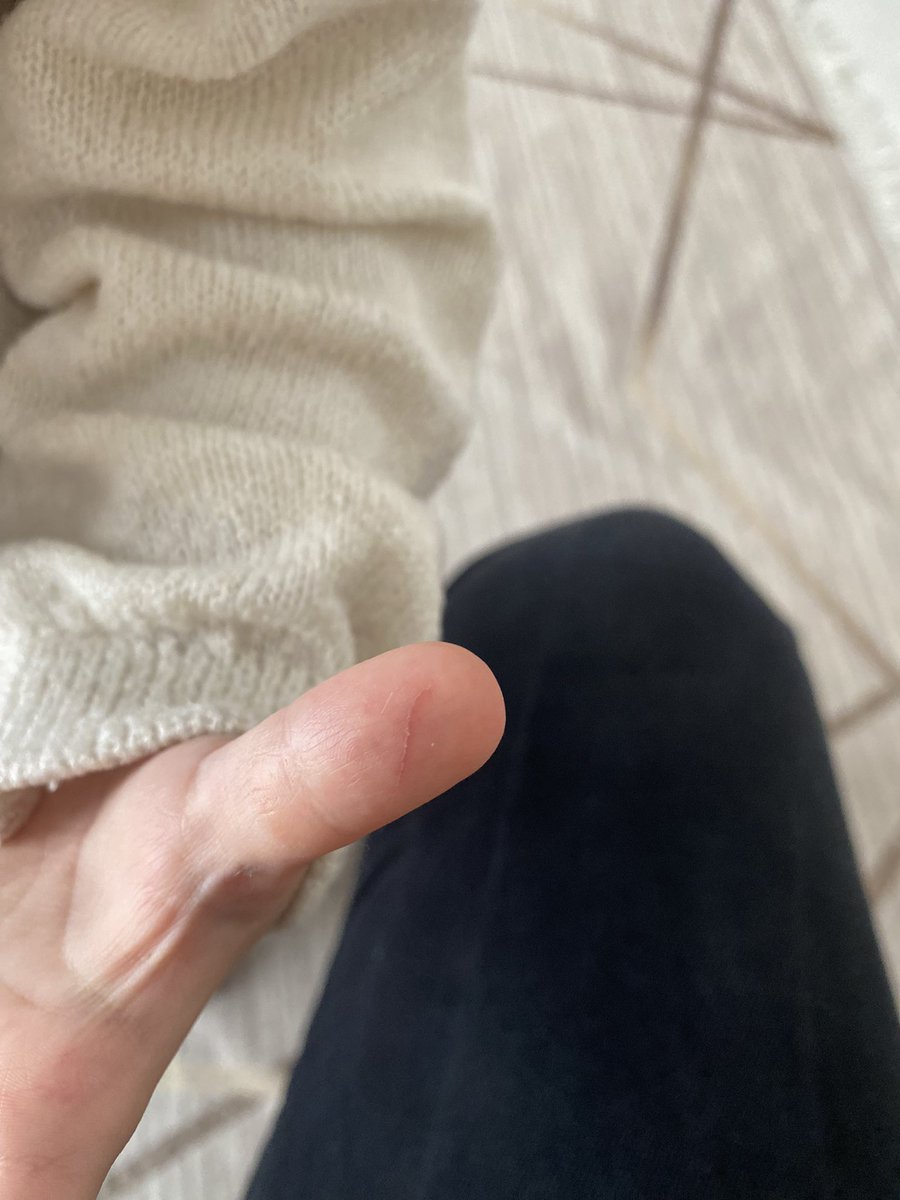 “Offf öğretmenim zaten okula yaralı yaralı geliyorum” bahsedilen (yara)