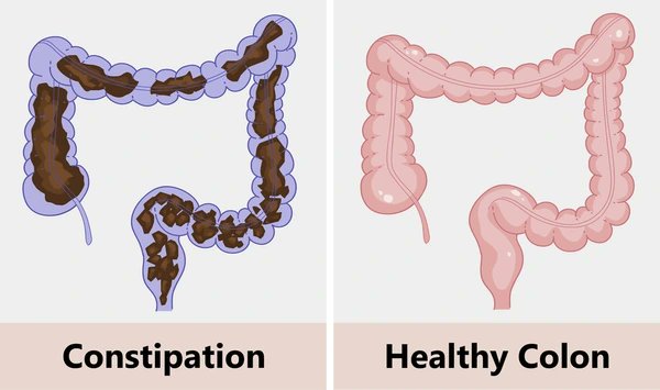 Colon cleansing is the most powerful yet ignored health intervention.

It fixes chronic fatigue, skin problems, and weak immunity.

I've tested this myself, and it does wonders.

Here's how to perform a colon cleanse the right way: 

Check Thread 👇
