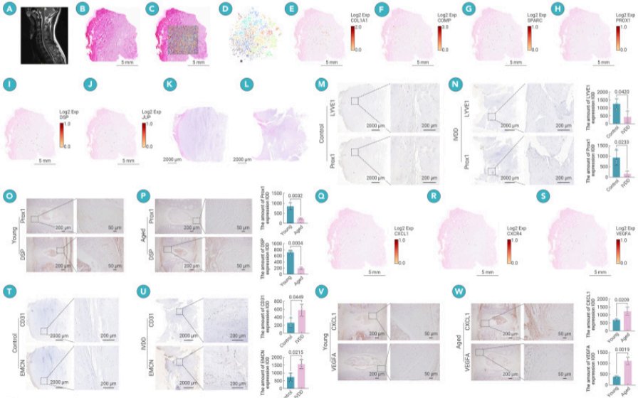 DavidMackeyDPT's tweet image. New research challenges belief that healthy intervertebral discs do not have lymphatic supply and suggests it may allow them to alleviate inflammation within the discs. This may open up new possibilities for future treatments of degenerative disc disease.
sciencedirect.com/science/articl…