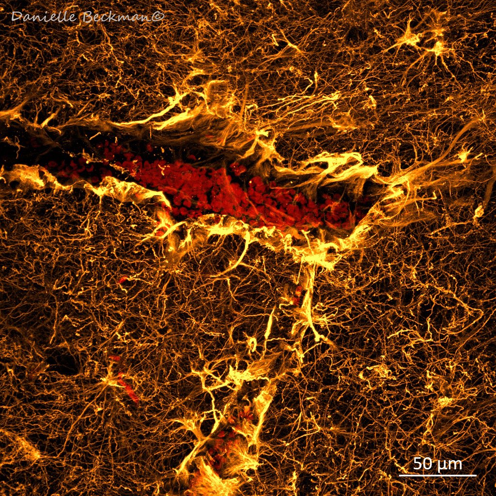 DaniBeckman's tweet photo. If you ever hear someone say "It feels like my brain is on fire", don't psychologize them. This is what neuroinflammation looks like. 
Imagine being a red blood cell whose only mission is to deliver oxygen, only to find a river of fire waiting for you inside the brain.#NeuroCovid https://t.co/vBe3tZDOGQ