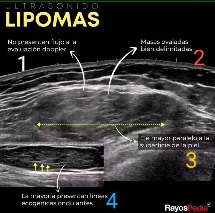 Ecografía de lipoma. ¿Quieres saber lo fundamental?

1. No hay flujo en la evaluación Doppler
2. Masa oval bien definida
3. Eje largo paralelo a la superficie de la piel
4. La mayoría tiene líneas ecogénicas ondulantes