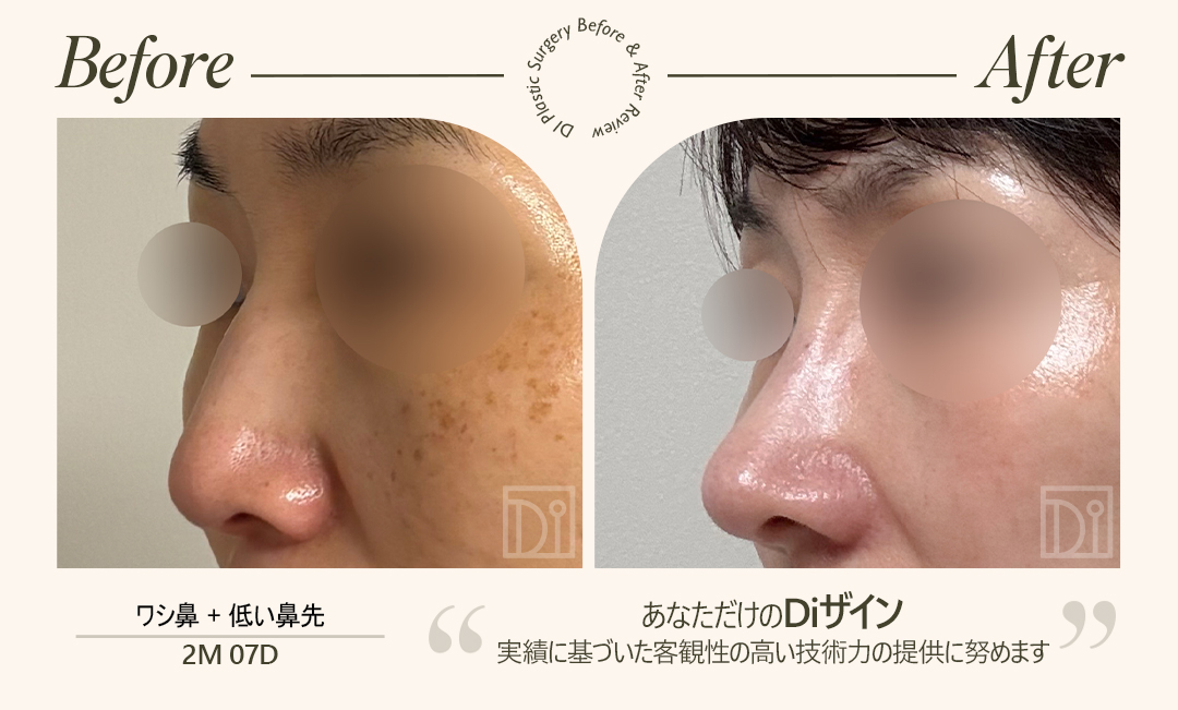 diprsjp's tweet photo. ✨DIの症例📷 

自分に似合うライン 
どの角度から見ても完璧に! 

 左before写真 / 右after写真 
・鼻手術 (自己肋骨形成) 

普段、低くて太っている鼻先が悩みでした😆
 💝あなただけのDiザイン  💝
実績に基づいた客観性の高い技術力の提供に努めます

お問い合わせは公式LINEにて
お待ちしております↓  
  
@574lbeop https://t.co/YpKlZ5bLE2 

#韓国整形外科 #韓国鼻整形 #韓国整形 #韓国鼻手術 #韓国整形情報 #韓国整形症例 #鼻整形症例 #韓国鼻整形症例 #鼻フル #団子鼻 #短い鼻 #自己肋軟骨 #鼻肋軟骨 #肋軟骨手術 #鼻手術 #鼻整形 #鼻再手術 #ハンプ手術 #ハンプ鼻 #ハンプ鼻手術 #鼻整形 #韓国鼻整形 #プロテーゼ #鼻中隔延長 #韓国鼻整形おすすめ #韓国整形外科おすすめ #韓国整形外科 #DI整形外科