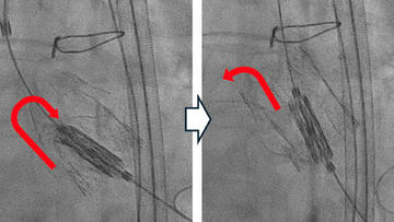 PCRonline 🫀 (@pcronline) on Twitter photo New challenges during transcatheter aortic valve-in-valve implantation inside a degenerated sutureless bioprosthesis
🔗pcronline.com/Cases-resource…
<a href="/ignamatsant/">Ignacio J. Amat</a> and team share this case and image that show how the collision of a TAV device during valve crossing in ViV #TAVI can New challenges during transcatheter aortic valve-in-valve implantation inside a degenerated sutureless bioprosthesis
🔗pcronline.com/Cases-resource…
<a href="/ignamatsant/">Ignacio J. Amat</a> and team share this case and image that show how the collision of a TAV device during valve crossing in ViV #TAVI can