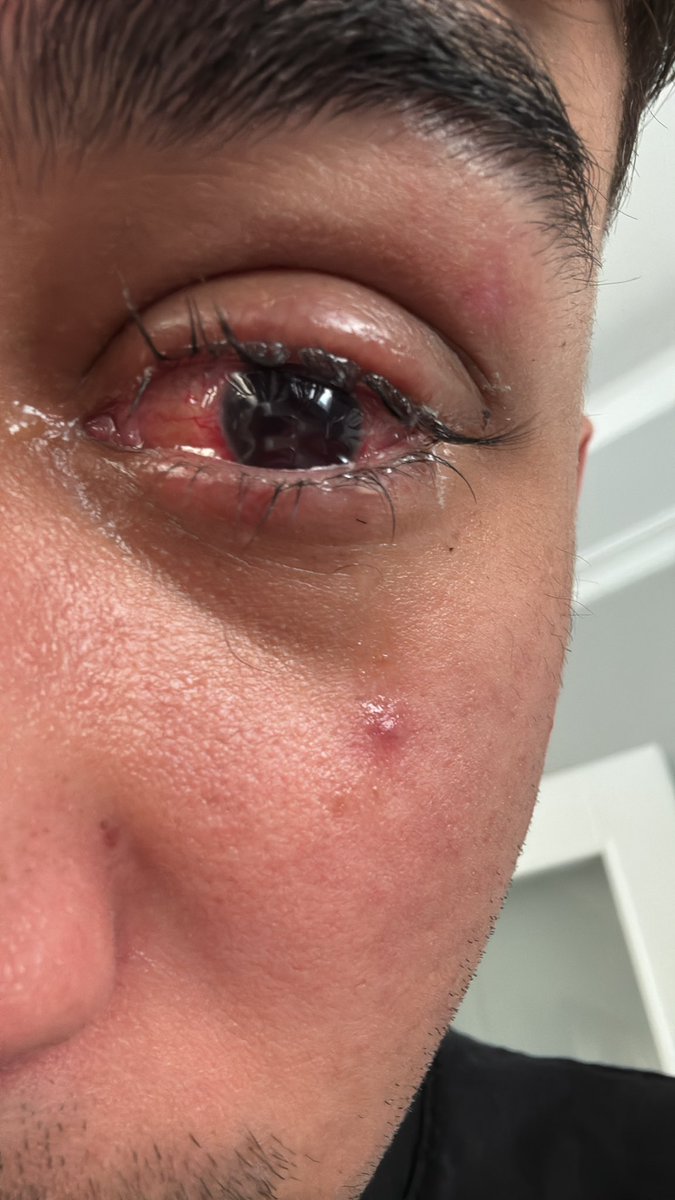 Gözümle ilgili son durum: Normalde silikon konulması planlanıyordu ama doktorlar gözün arkasına gaz koymayı tercih etti. Katarakt ameliyatı yapıldı, mercek de takıldı. İyileşme sürecindeyim, 2 hafta daha göremeyeceğim ama bu gelişmeler iyiye işaret. Sabırla, umutla!