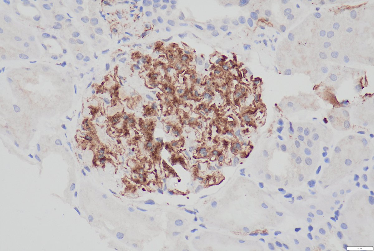 75 yr/f diagnosed with SLE in 2022,h/o oral ulcers,ANA +ve 1:640
No h/o joint pain,rash, photosensitivity
Evaluation in 2025 shows sub-nephrotic proteinuria Urine routine protein 1+, RBC -1-2 
HE PAS Silver IF clue. IHC throws a surprise. 
Diagnosis ? Identify the diagnostic IHC