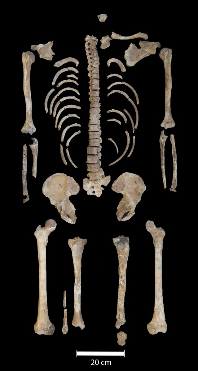 hannes_rathmann's tweet image. Ouch! This Celtic warrior took an arrow to the butt 🏹But thanks to some surprisingly advanced ancient medics, he survived! A peek into healthcare 2,500 years ago: doi.org/10.1002/oa.3395