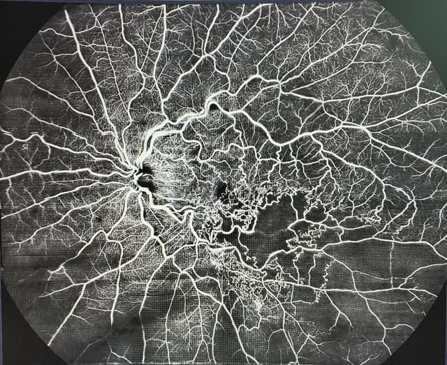 toward_pi's tweet photo. Branch retinal vein ocusion
📸 Reposted from Centro Italiano Macula
#Ophthalmology #sweptsourceoct #SSOCTA #towardpi #retina https://t.co/X1KIA2xWFD