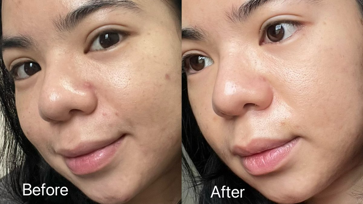 ใครเป็นสิวมีรอยเยอะ อยากแนะนำโฟมของเมนโทลาทั่มตัวนี้ดีมาก Mentholatum Acnes Clear & Whitening Wash เขาใช้ได้กับสิวที่เกิดขึ้นทุกระยะ ที่สำคัญคืออ่อนโยน เพราะเป็นเวชสำอางธรรมชาติ ใช้ได้กับทุกสภาพผิวเลย อ่อนโยนต่อผิวสุด ราคาน่ารักด้วย ถูกและดีมีอยู่จริง อีกหนึ่งไอเท็มลดสิว ลดรอยที่แนะนำเลย หาซื้อได้ง่ายๆที่เซเว่นน้า
#โฟมล้างหน้าคนเป็นสิว #โฟมลดสิวเซเว่น #เมนโทลาทั่มแอคเน่ส์
