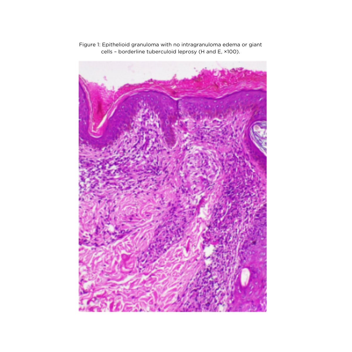 🆕 New paper alert:

Role of histopathology and HLA-DR expression in predicting lepra reactions: A retrospective analysis by Sarita Sasidharanpillai et al

Read the paper: leprosyreview.org/article/96/1/2…

#Leprosy #OpenAccess #Research #Health #GlobalHealth #Epidemiology #IDTwitter