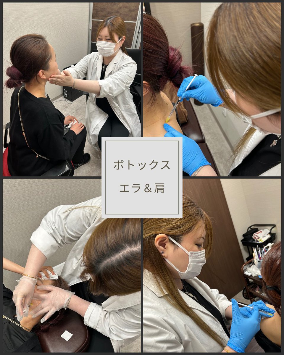 JBCclinic's tweet photo. ✨ボトックス✨
以前より肩こりに悩み
アートメイク施術時はよく��いしばってしまい
エラが気になるとのこと！
久保先生に相談し、エラと肩にボトックスを施術していたきました😆

#エラボト
#ボトックス
#肩ボトックス
#食いしばり
#肩こり
#アートメイク
#ボトックス大阪 https://t.co/tRWH1wK7R4