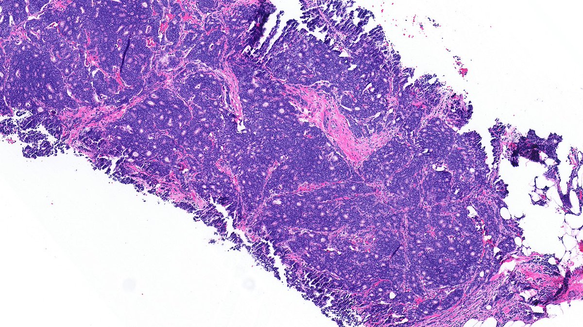 Case of Invasive Papillary Carcinoma 🔬

Invasive papillary carcinoma shows an infiltrative and complex growth of epithelial cells on arborizing fibrovascular stalks.

#PathX #PathTwitter #breastpath