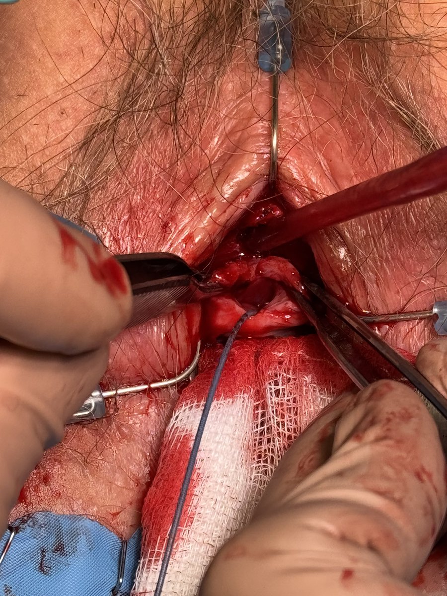 DavidCarracedoC's tweet photo. Female ureteral stricture is an uncommon but underdiagnosed condition. Lichen sclerosus is the most common cause. 

Dorsal urethorplasty with oral mucosal graft is an effective treatment.

Another procedure performed at @HUReyJuanCarlos 

@MiguelSEncinas 
@tamaraizje 
@InfoAeu https://t.co/ILLVBUGdVw