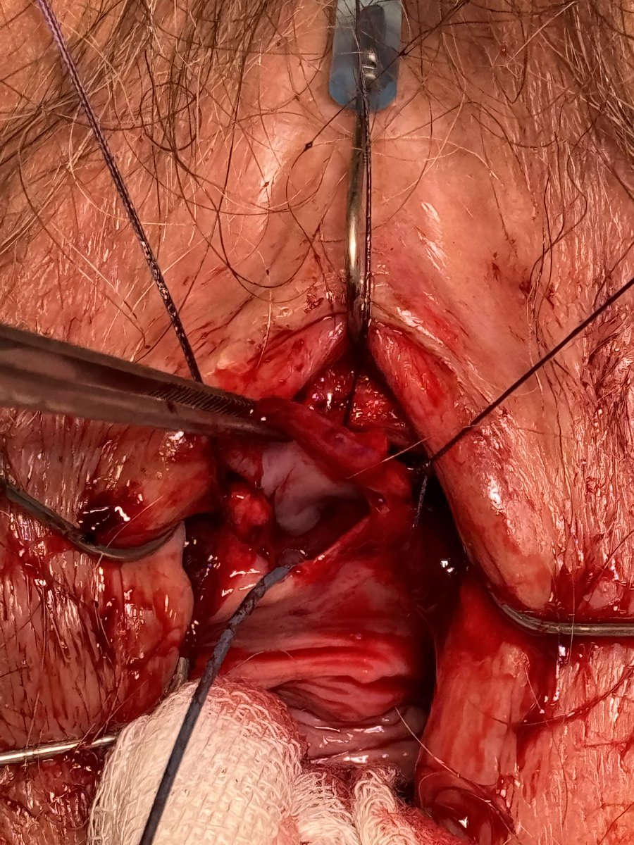DavidCarracedoC's tweet photo. Female ureteral stricture is an uncommon but underdiagnosed condition. Lichen sclerosus is the most common cause. 

Dorsal urethorplasty with oral mucosal graft is an effective treatment.

Another procedure performed at @HUReyJuanCarlos 

@MiguelSEncinas 
@tamaraizje 
@InfoAeu https://t.co/ILLVBUGdVw