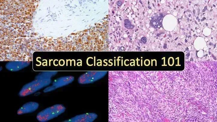 JMGardnerMD's tweet photo. Sarcoma 101 - Bone &amp; Soft Tissue Tumor Classification/Names Made Simple video: https://t.co/9OwCAOEWrK . My 2021 lecture for NCI SEER cancer registrars. Also good for #medstudents, jr. #pathologists, ortho/oncology, &amp; patients/family. #medtwitter #pathology #orthotwitter https://t.co/PnXQyi5Cws