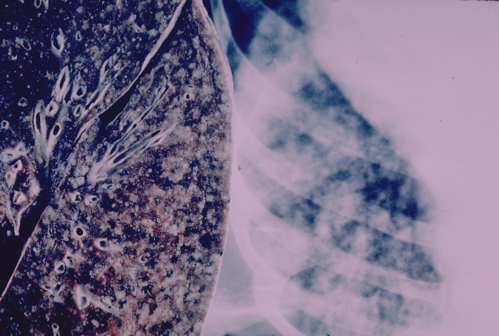🗣️ "Efforts to decolonize global health must also parallel efforts to address other related injustices."

Read "Missed Nuances in Tuberculosis Research: Reflections from a Tibetan Scholar" by Nawang Yanga.

Available here: bit.ly/3RKqsxQ

#decolonize #globalhealth